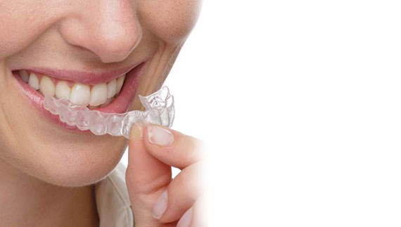 Clear Aligners for adults